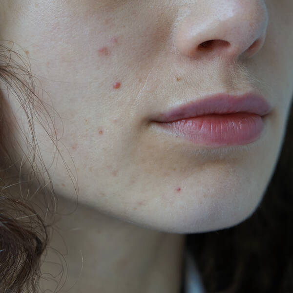A-DERMA: Hudplejerutinen mod bumser og hudorme